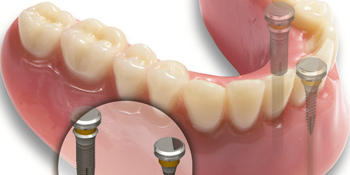 Implantes